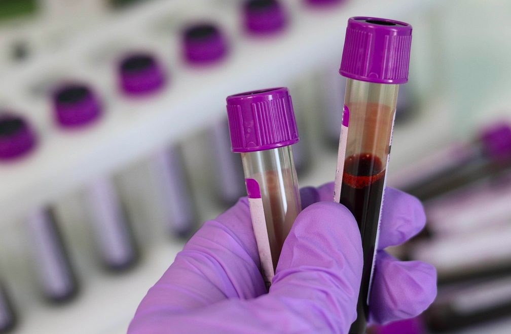 Advances in Parkinson’s Diagnostic Techniques