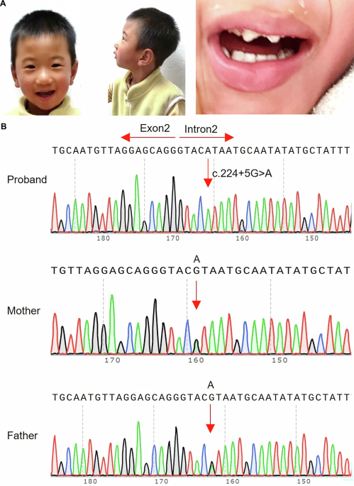 Microcephaly-related global developmental delay caused by a pathogenic METTL5 splicing mutation in a Chinese family