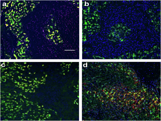 Nasopharyngeal carcinoma: a model cancer to understand tumor rejection