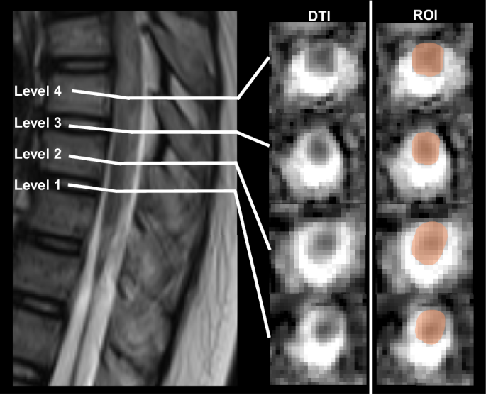 Using diffusion tensor imaging to assess children with spinal cord injury without fracture or dislocation