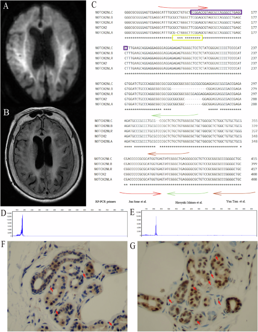 Detection and characterization of rare variants in NOTCH2NLC causing false negative molecular diagnosis through long-read sequencing
