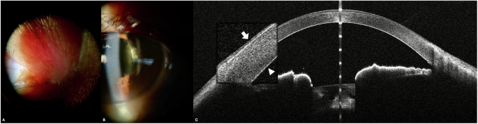 Ocular argyrosis
