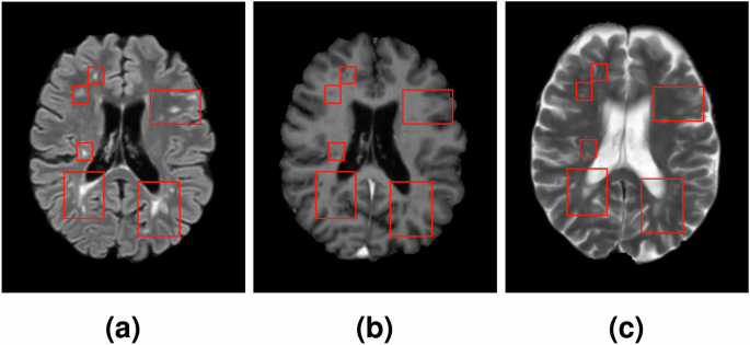 MSLesSeg: baseline and benchmarking of a new Multiple Sclerosis Lesion Segmentation dataset