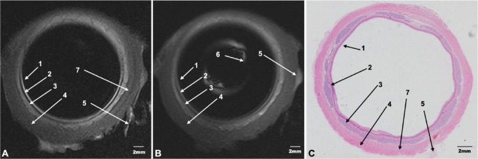 Ex vivo study of Porcine esophagus magnetic resonance imaging with a compact endoluminal coil
