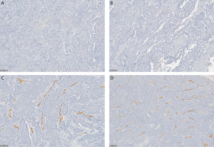 High CD36 expression in the tumor microenvironmental vasculature correlates with unfavorable overall survival in high grade serous ovarian cancer