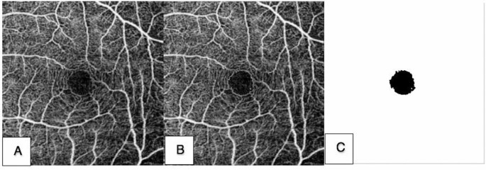 Correlation of optic nerve hemoglobin levels with structural and functional parameters in glaucoma