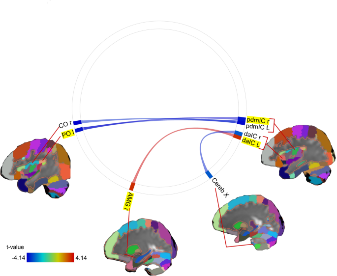 A multicenter cross-sectional study to elucidate altered resting-state functional connectivity of the insular cortex in anorexia nervosa, segmented by functional localization