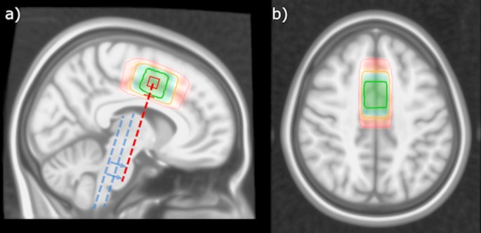 GABA, glutamate dynamics and BOLD observed during cognitive processing in psychosis patients with hallucinatory traits