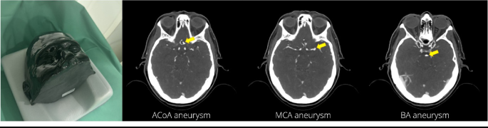Inconsistency of AI in intracranial aneurysm detection with varying dose and image reconstruction