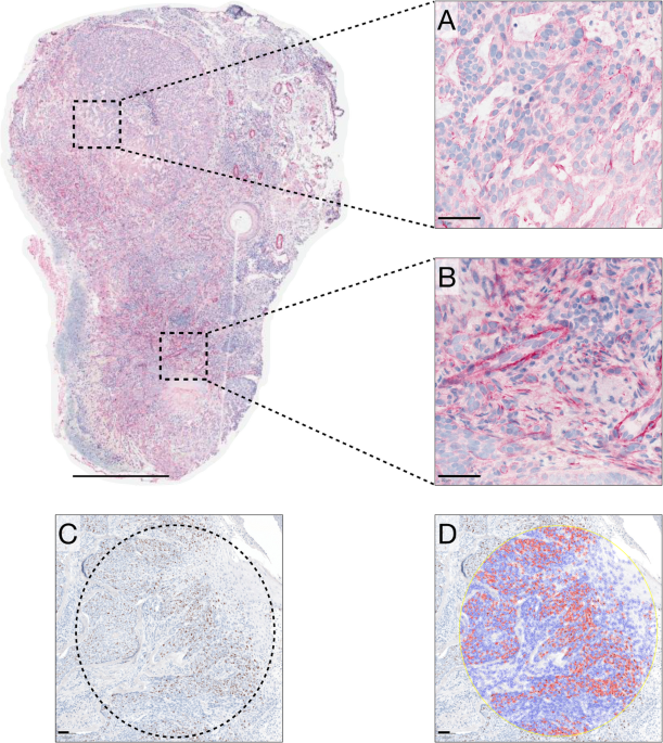 Immunohistochemical expression of smoothened in periocular basal cell, squamous cell and sebaceous carcinomas