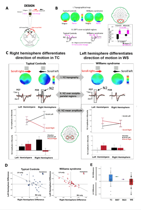 Brain lateralization for perceiving direction of motion is reversed in Williams syndrome and related to BUD23