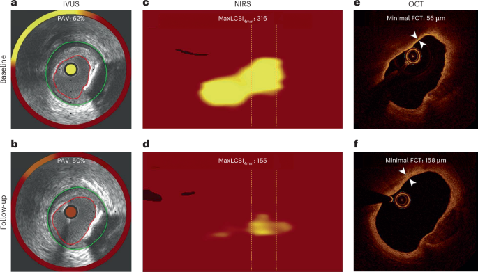 The sequence of changes in intravascular imaging findings during lipid-lowering therapy and its implication