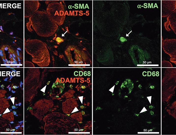 ADAMTS-5 inhibition reduces muscle inflammation and fibrosis and improves function in mouse models of Duchenne muscular dystrophy | Science Translational Medicine