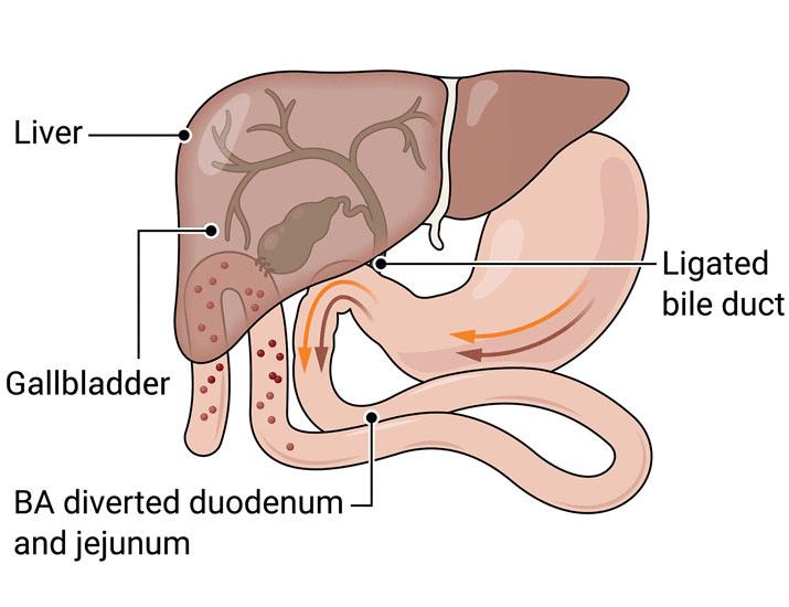 Bile diversion underlies Roux-en-Y antitumor benefits | Science Translational Medicine