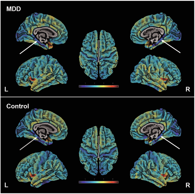 7-Tesla ultra-high field MRI of the parahippocampal cortex reveals evidence of common neurobiological mechanisms of major depressive disorder and neurotic personality traits