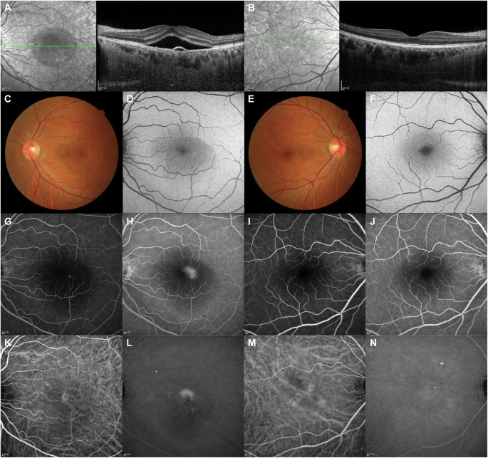 Treatment of central serous chorioretinopathy: new options for an old disease