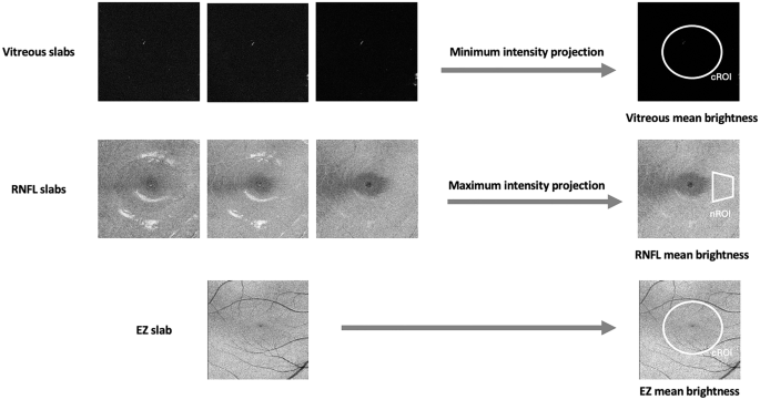 Photoreceptor damage in pachychoroid pigment epitheliopathy