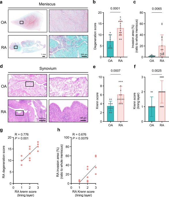CD142-positive synovial fibroblasts drive meniscus destruction in rheumatoid arthritis