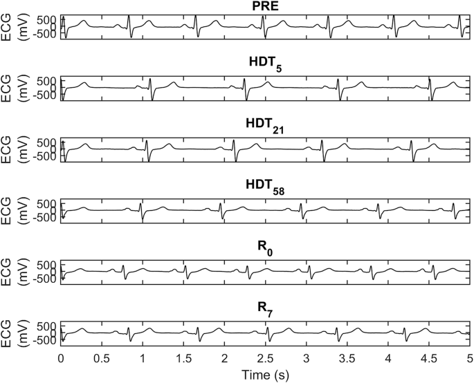 Heart rate variability adaptation due to head-down tilt bed rest: insights from pooled data of six campaigns