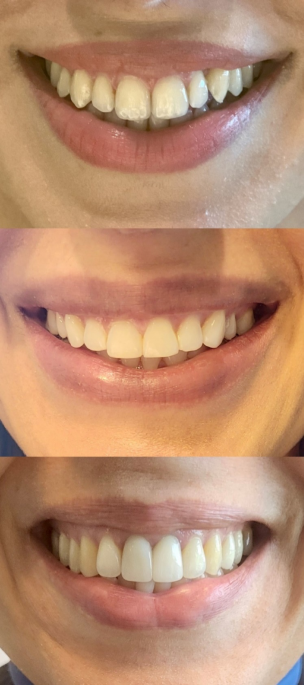 Impact of fixed orthodontic treatment with and without premolar extraction on gingival display index in men and women