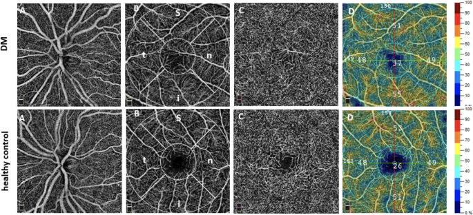 Altered microvasculature in patients with adult-onset dermatomyositis using optical coherence tomography angiography