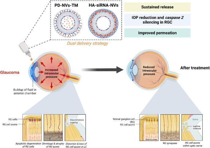 Peptide dendrimer and hyaluronic acid modified nanovesicles for ocular delivery of timolol maleate and siRNA