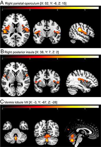 Functional brain activity in persistent postural-perceptual dizziness (PPPD) during galvanic vestibular stimulation reveals sensitization in the multisensory vestibular cortical network