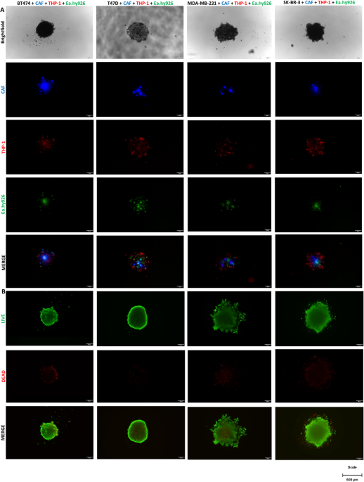 Development of tetraculture spheroids as a versatile 3D model for personalized breast cancer research