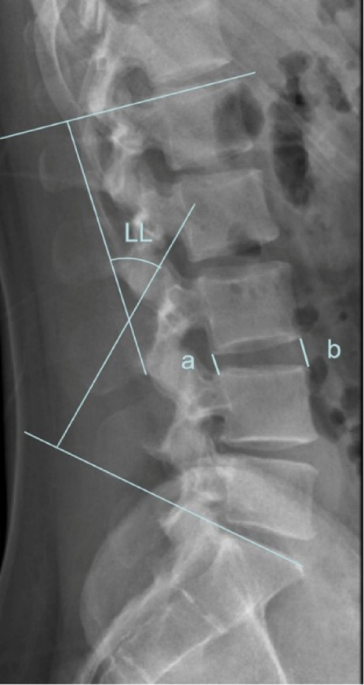 Unilateral versus bilateral pedicle screw fixation for treating two-level lumbar degenerative diseases