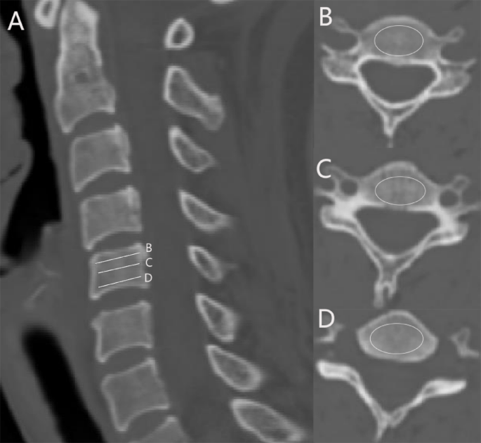 Osteoporosis in adjacent cervical segments exacerbates disc herniation