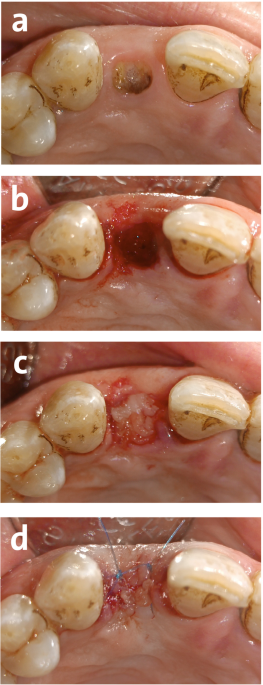 Titanium-prepared platelet-rich fibrin enhances alveolar ridge preservation: a randomized controlled clinical and radiographic study