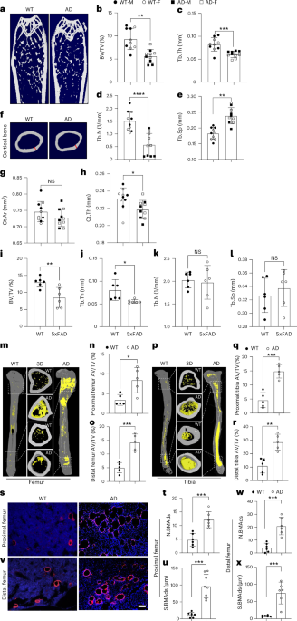 Serum amyloid P secreted by bone marrow adipocytes drives skeletal amyloidosis