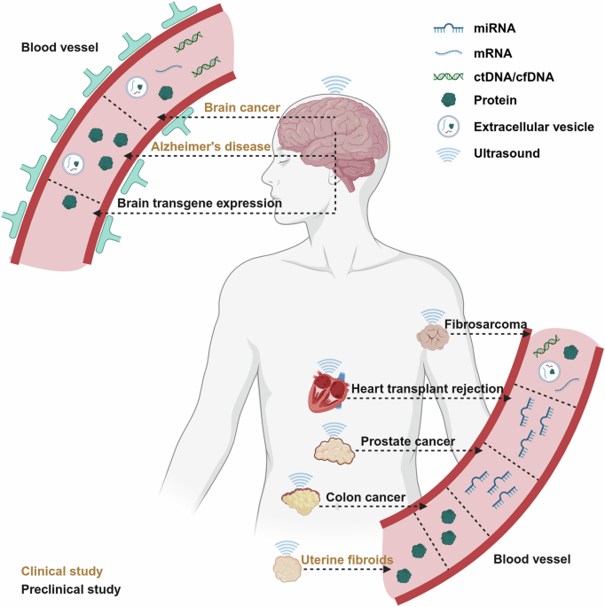 Sonobiopsy for sensitive and spatially targeted molecular diagnosis through integrating ultrasound with liquid biopsy