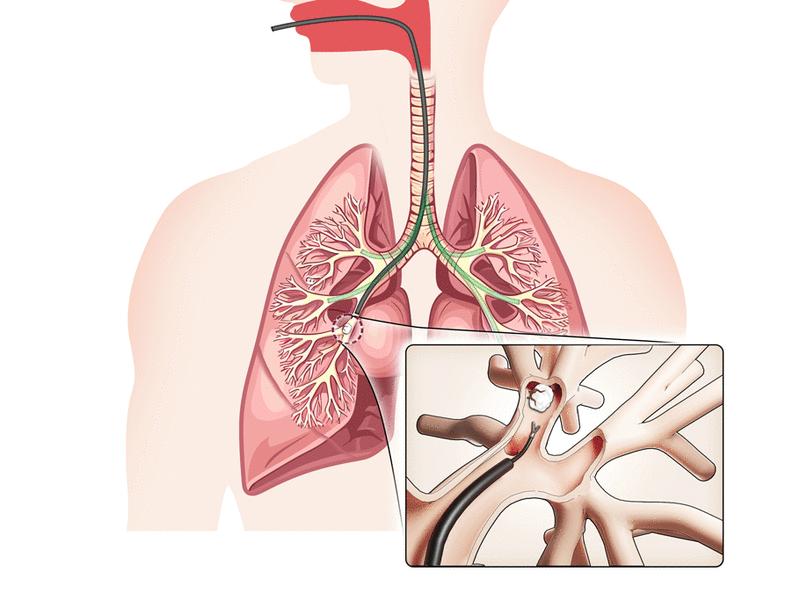 AI search, physician removal: Bronchoscopy robot bridges collaboration in foreign body aspiration | Science Robotics