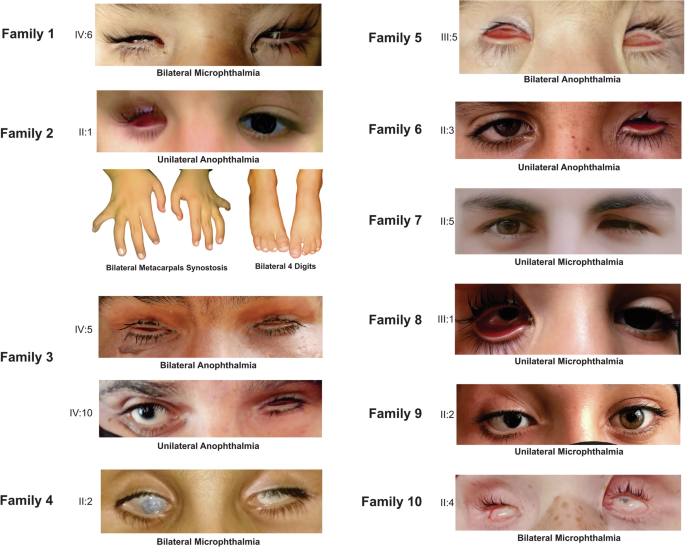 Genotypic and phenotypic spectrum of anophthalmia/microphthalmia in families from Khyber Pakhtunkhwa, Pakistan