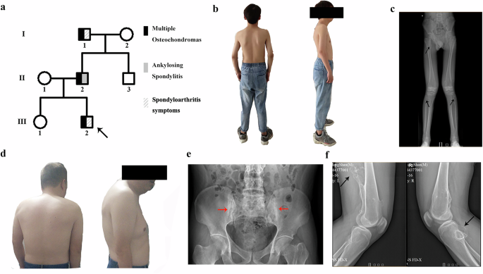 Identification of an IL17RC missense variant in a Chinese family with multiple osteochondromas and ankylosing spondylitis
