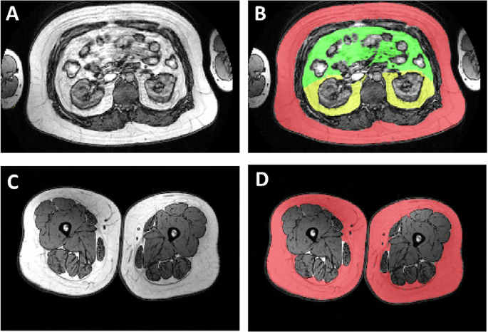 Differential associations of subcutaneous and visceral fat with bone turnover markers: A study on bariatric surgery patients with severe obesity and individuals without obesity