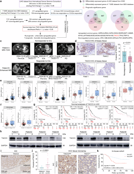 Transforming acidic coiled-coil-containing protein 3-mediated lipid metabolism reprogramming impairs CD8+ T-cell cytotoxicity in hepatocellular carcinoma