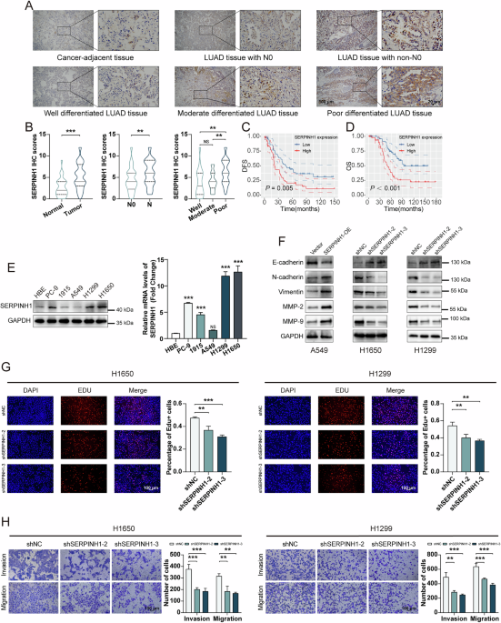 A positive feedback loop between SERPINH1 and MMP-9/TGF-β1 promotes lung adenocarcinoma progression
