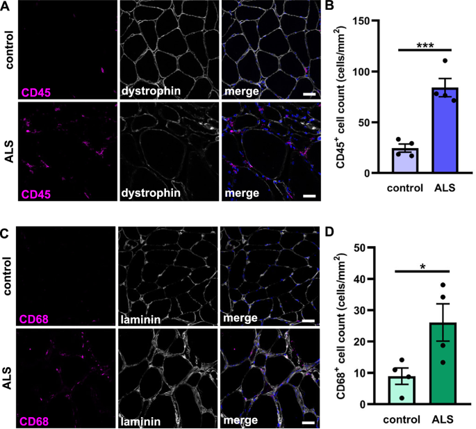 The CCL2-CCR2 axis drives neuromuscular denervation in amyotrophic lateral sclerosis