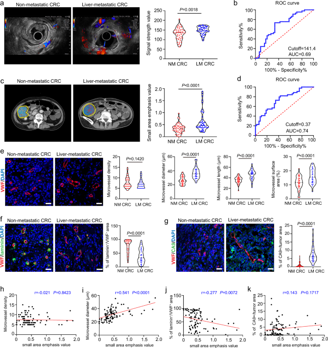 Pericytes promote metastasis by regulating tumor local vascular tone and hemodynamics