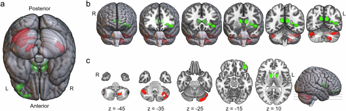 Impact of impulsivity on the relationship of the brain structures with school performance