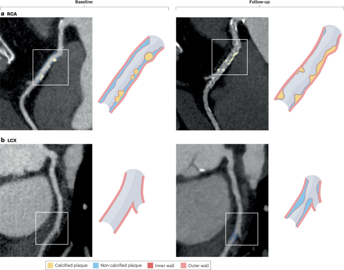 Coronary CT angiography evaluation with artificial intelligence for individualized medical treatment of atherosclerosis: a Consensus Statement from the QCI Study Group