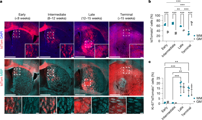 Axonal injury is a targetable driver of glioblastoma progression