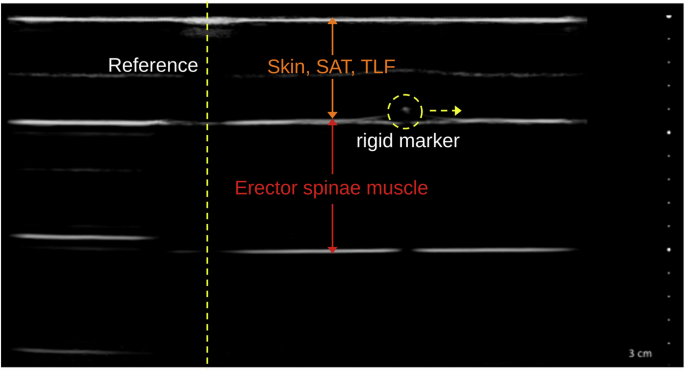 Ground truth and demographic data for ultrasound assessment of thoracolumbar fascia deformation and shearing