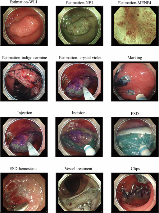 Renji endoscopic submucosal dissection video data set for colorectal neoplastic lesions