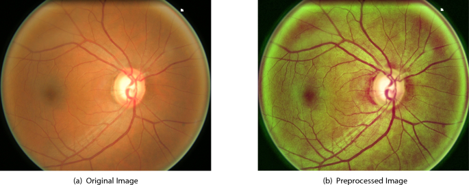 A novel method for optic disc localization using fast circlet transform and Chan-Vese segmentation