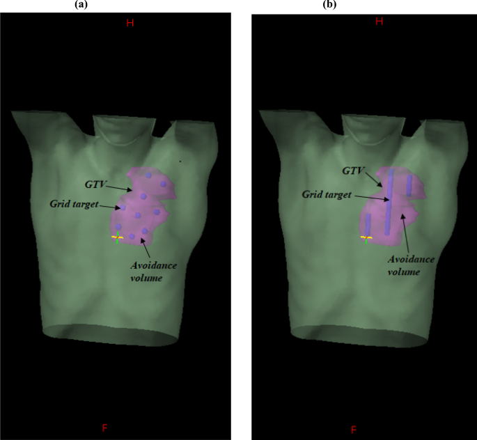 Modeling the impact of intercellular signaling on dose metrics and therapeutic outcomes in spatially fractionated radiation therapy (SFRT) for lung cancer