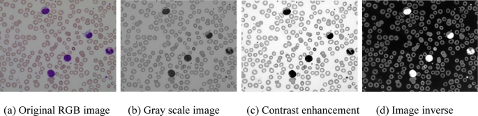 Acute lymphoblastic leukemia diagnosis using machine learning techniques based on selected features