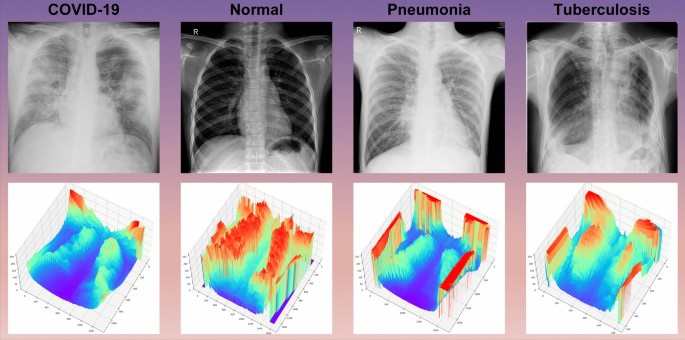 Pulmonary diseases accurate recognition using adaptive multiscale feature fusion in chest radiography